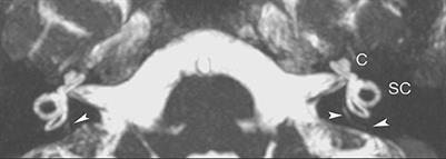 Simplified MR imaging of the inner ear in patients with Ménière's disease